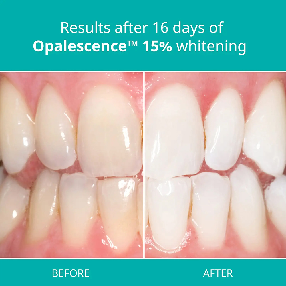 Kit de Gel blanqueador de dien - Teeth Whitening Gel Opalescence reseña y precio