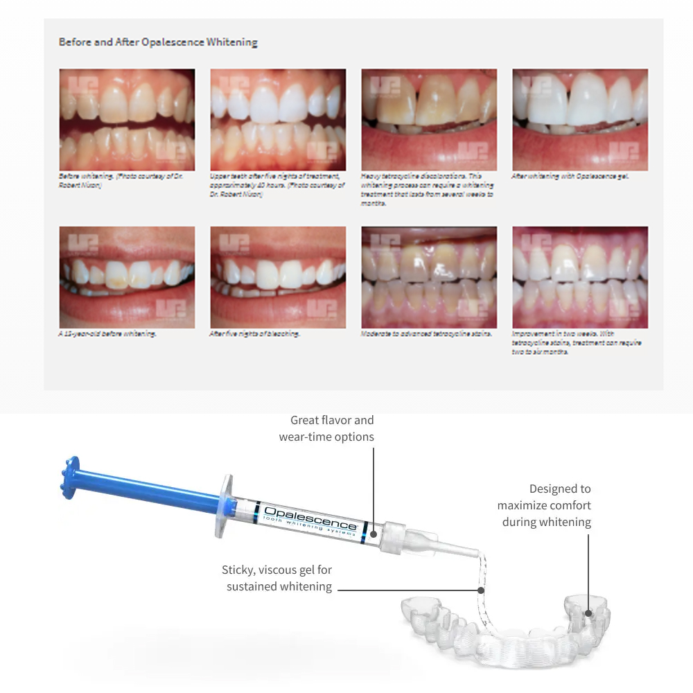 Opalescencia blanqueadora 20%  - Teeth Whitening Before And After reseña y precio