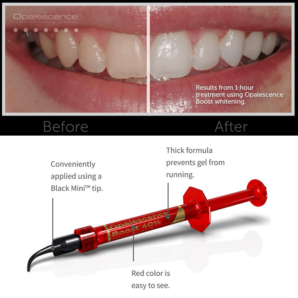 Gel Blanqueador Dental Ultrade - Teeth Whitening Gel Opalescence reseña y precio